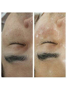 エミット(emit.)/ララピール　ビフォーアフター