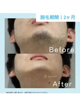 メンズクリア エルパプラス福井店/【メンズクリア】お客様の施術例