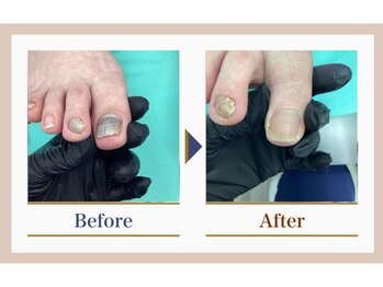 巻き爪補正店 錦糸町店/【変形爪再生補正】