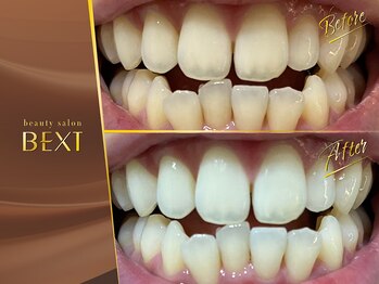 ベクスト(BEXT)/セルフホワイトニング