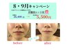 30名様限定★むくみ!! 脂肪燃焼!! 小顔水素フェイシャル水素吸入付