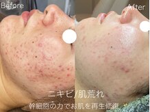 ラティーナ(Lattina)の雰囲気（全体ニキビ/毛穴/肌荒れを繰り返す方におすすめ♪根本から改善）