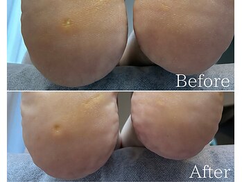 カシェット 広島店(Cachette)/40代女性☆足裏角質ケア90分