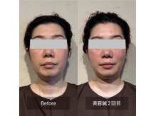 菫鍼灸院の雰囲気（頭皮鍼付き全顔美容鍼で、左右差やたるみを改善します）