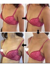 ソラ(SORA)/バストアップ症例