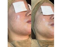 アトレ(Atre)/ゾンビエステ★