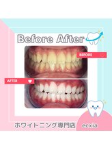 エクシアホワイトニング 札幌中島公園店/BeforeAfter［ホワイトニング］ 