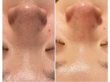 ラインビューティ 上野 御徒町(LINE BEAUTY)/正規取扱ハイパー&毛穴洗浄