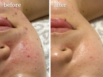 メルシア(merucia)/跡、ニキビケア、赤み改善