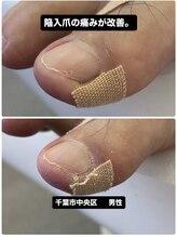 巻き爪じゅん 船橋店/セルフカットで悪化する巻き爪！