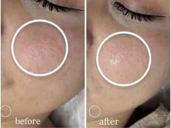 アンリミット 鹿児島天文館店(Une limit)/赤みがお悩みの方へ