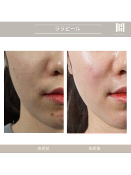 カリスボーテ 関本店/第四世代ララピール