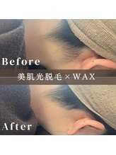 エピナ 横浜店(Epina)/うなじ脱毛/ブライダル脱毛