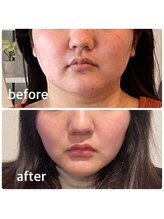 ルブラン(Le Blanc)/頭蓋骨小顔矯正