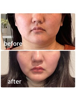 ルブラン(Le Blanc)/頭蓋骨小顔矯正