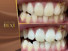 ベクスト(BEXT)/セルフホワイトニング