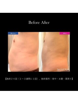 メンズエフディ ファウンデーション(メンズFD)/痩身メニュー