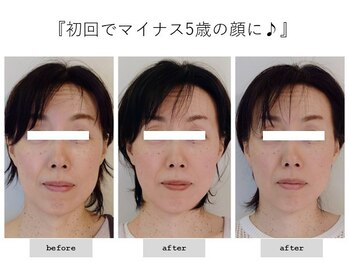 エピファニー(Epiphany)/40代　左右差やたるみ、大きさが