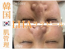 グレイティア(gratia)の雰囲気（ララピール/3回目/ゴワツキ軽減/毛穴引き締め/シワシミケア/艶肌）