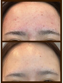 アトワ(A toi)/ハーブピーリング(棘あり)