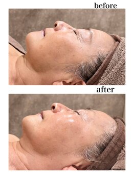 銀座レイア/ハリ！リフト！潤い！VAR