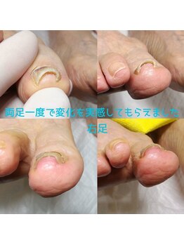 【巻き爪ケア】ネイル/フット