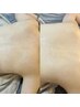 【滑らかな背中へ】背中ハーブピーリング¥15000→¥12000