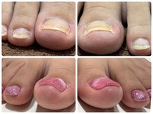 ラフィング(Laughing)/巻爪矯正