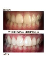 ホワイトニングショップ 妙高店(whiteningshop)/【Before after】理想の白さに！