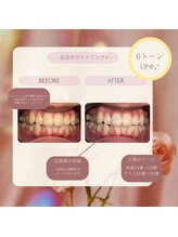 プラスビー 2号店(+b)/ホワイトニングビフォーアフター