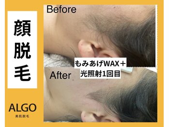 アルゴ 山口店(ALGO)/顔脱毛