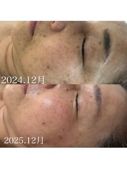 ステライチマルサン(stella.103)/赤み、くすみケア