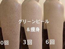 バービーグロウ 恵比寿(Barbie Glow)/二の腕 グリーンピールand痩身　