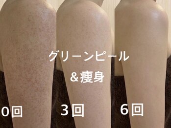 バービーグロウ 恵比寿(Barbie Glow)/二の腕 グリーンピールand痩身　