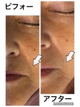 ディオーネ 朝霞台店(Dione)/人気のハイパー光フェイシャル