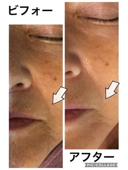 ディオーネ 朝霞台店(Dione)/人気のハイパー光フェイシャル