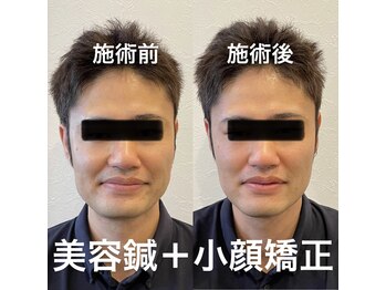 つばさ鍼灸院/エラ撃退!!美容鍼♪