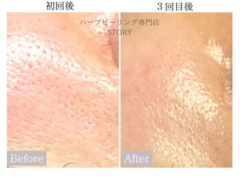 ストーリー(STORY)/ハーブピーリング専門店STORY