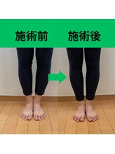 くぼてらたかひろ ボディメンテナンス(BODY MAINTENANCE)/O脚でお悩みのお客様　施術前後