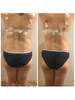 リボディ プラチナ(Rebody platinum)/脂肪冷却×ボディスカルプト