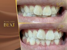 ベクスト(BEXT)/セルフホワイトニング