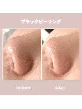 アネーロ(anhelo)/ブラックピーリング！