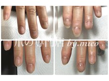ミコ(.mico)の雰囲気（自爪育成、深爪、巻き爪、変形爪の補正や再生を行っております。）