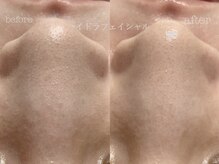 キアラ(CHIARA)の雰囲気（毛穴洗浄で毛穴に詰まった汚れをしっかり除去!肌もワントーンUP!）