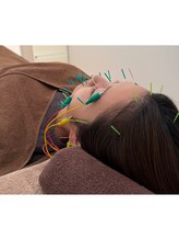 トイ鍼灸接骨院(TOY鍼灸接骨院)/●美容鍼