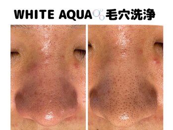 ホワイトアクア 柏店(WHITE AQUA)/メンズケア/毛穴改善/黒ずみ