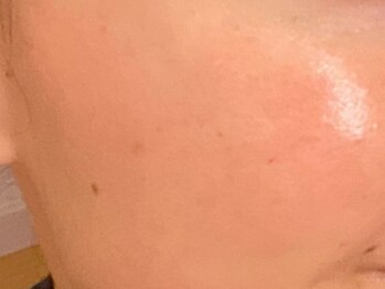 エミュ(emu)の写真/40代でも諦めない!シミケア毛穴レス肌を叶える美白ピール♪毛穴/シミに徹底アプローチ★美白促進ピーリング