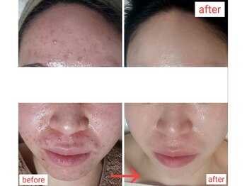 ミュー(Mieux)/続けてきてよかった！美肌に！