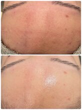 トリアングル(TLIENGLE)/ララピール　before　after