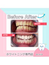 エクシアホワイトニング 札幌中島公園店/BeforeAfter［ホワイトニング］ 